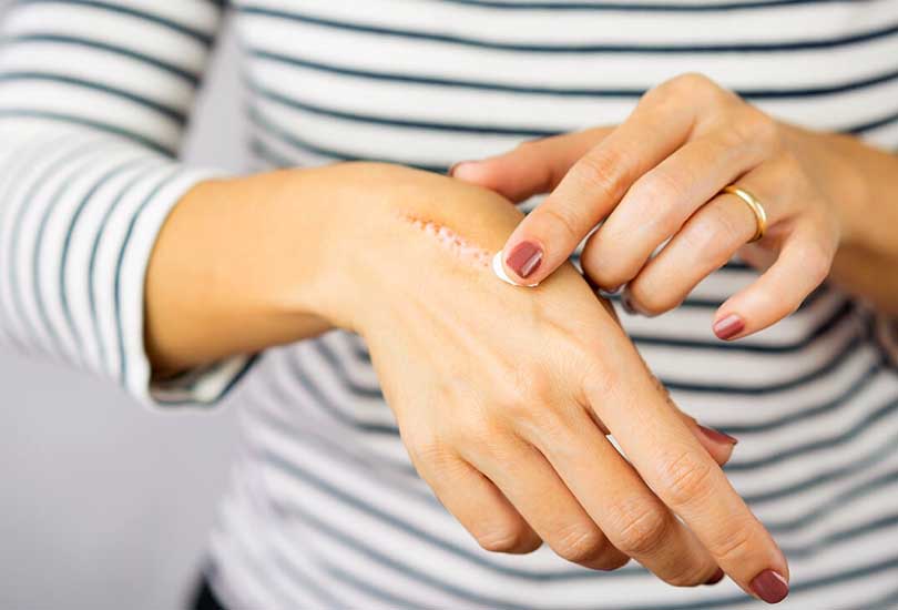 6 razones por las que ocurre una cicatrización lenta de heridas